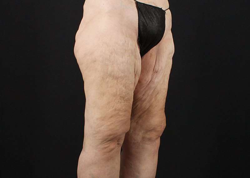 Thigh Lift Before & After Patient #1884
