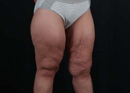 Thigh Lift Before & After Patient #1897