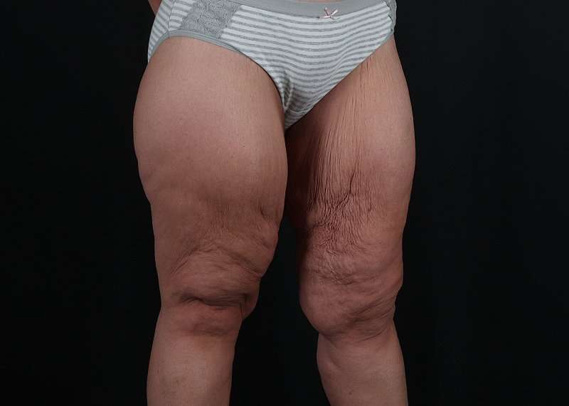 Thigh Lift Before & After Patient #1897
