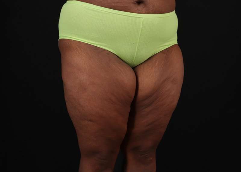 Thigh Lift Before & After Patient #1911