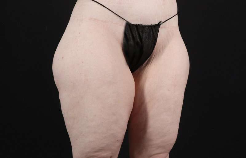 Thigh Lift Before & After Patient #1925