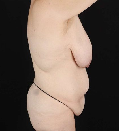 Back Lift/Tuck Before & After Patient #1939