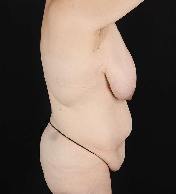 Back Lift/Tuck Before & After Patient #1939