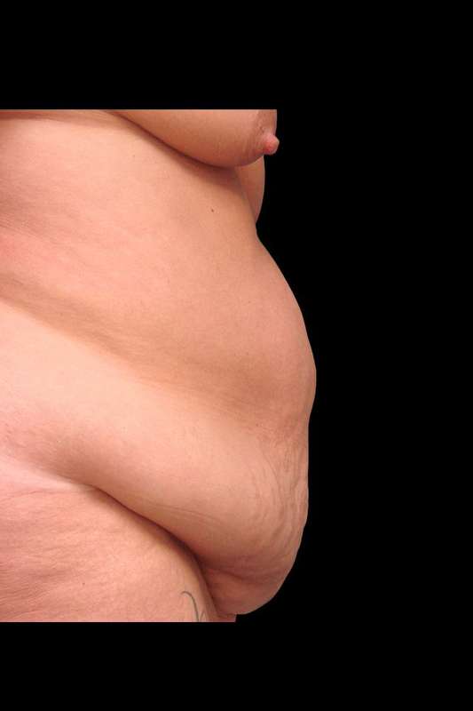 Abdominoplasty (Tummy Tuck) Before & After Patient #680
