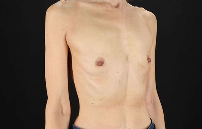 Breast Augmentation Before & After Patient #2110