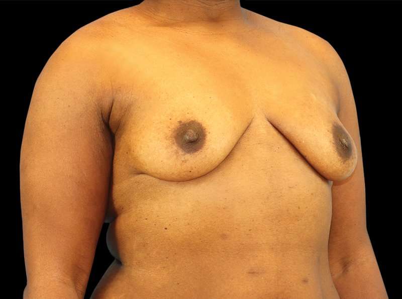 Breast Augmentation Before & After Patient #2121