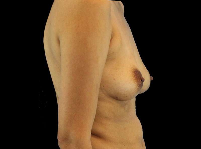 Breast Augmentation Before & After Patient #2129