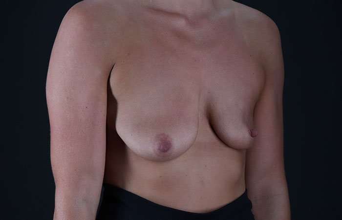 Breast Augmentation Before & After Patient #2281