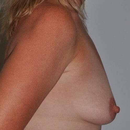 Breast Augmentation Before & After Patient #2286