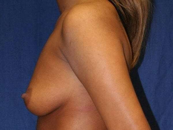Breast Augmentation Before & After Patient #2291
