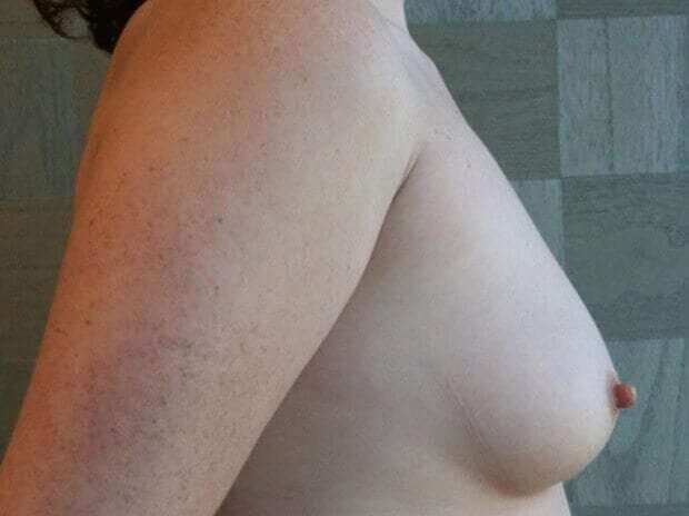 Breast Augmentation Before & After Patient #2297