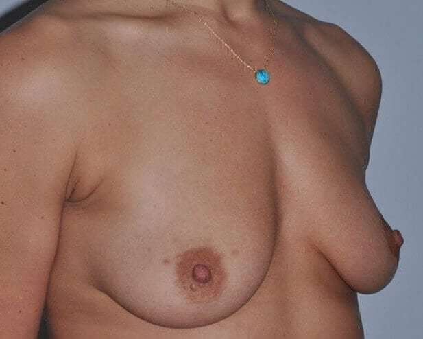 Breast Augmentation Before & After Patient #2307