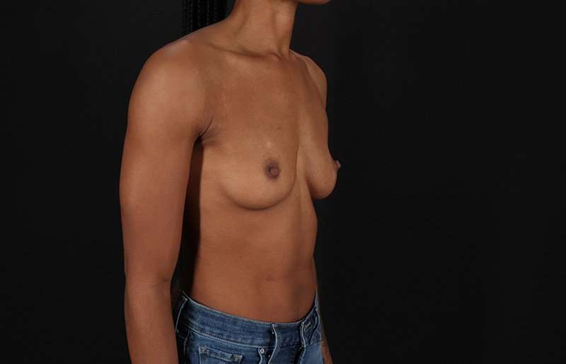 Breast Augmentation Before & After Patient #2376
