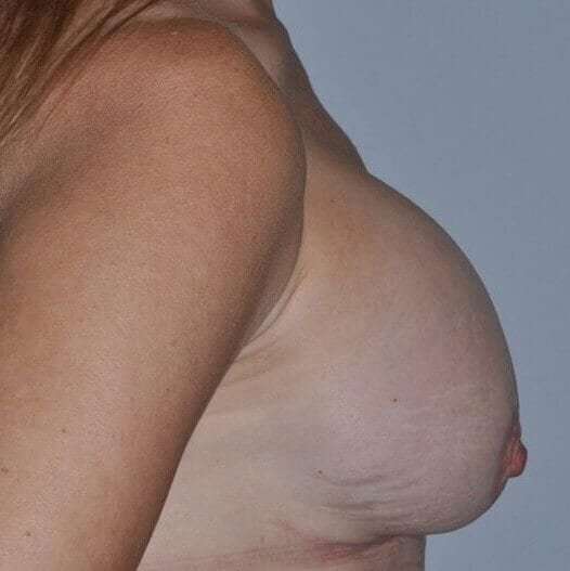 Breast Implant Revision Before & After Patient #2441