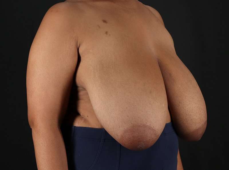 Breast Reduction Before & After Patient #2463