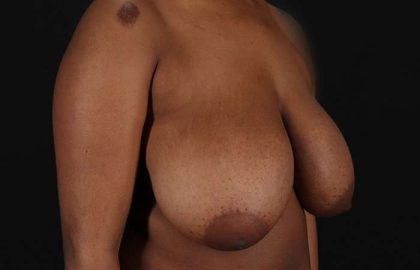 Breast Reduction Before & After Patient #2487