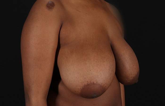 Breast Reduction Before & After Patient #2487