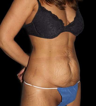 Abdominoplasty (Tummy Tuck) Before & After Patient #757