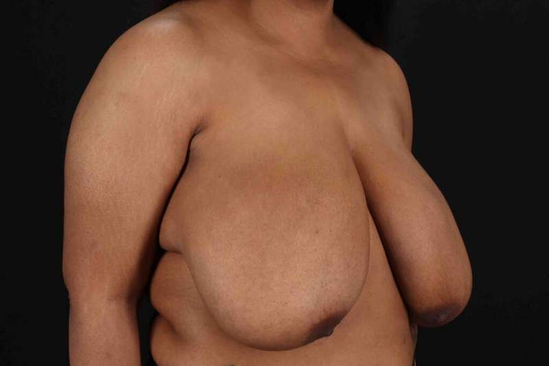 Breast Reduction Before & After Patient #2580