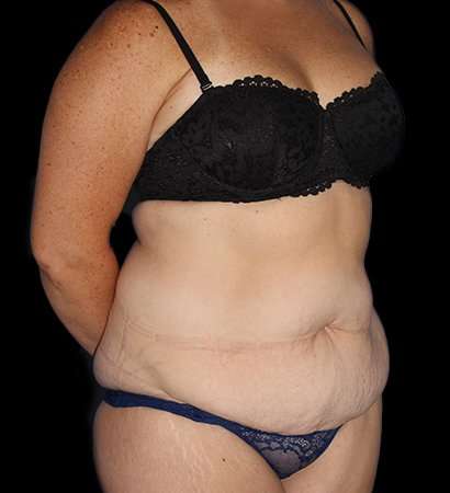 Abdominoplasty (Tummy Tuck) Before & After Patient #768