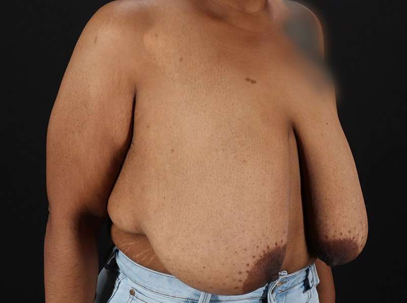 Breast Reduction Before & After Patient #2646