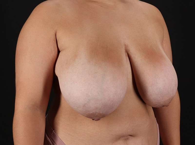 Breast Reduction Before & After Patient #2657