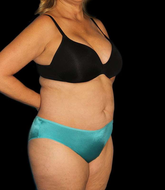 Abdominoplasty (Tummy Tuck) Before & After Patient #579