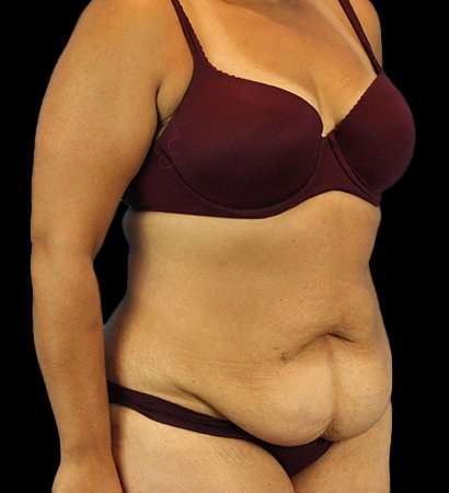 Abdominoplasty (Tummy Tuck) Before & After Patient #779