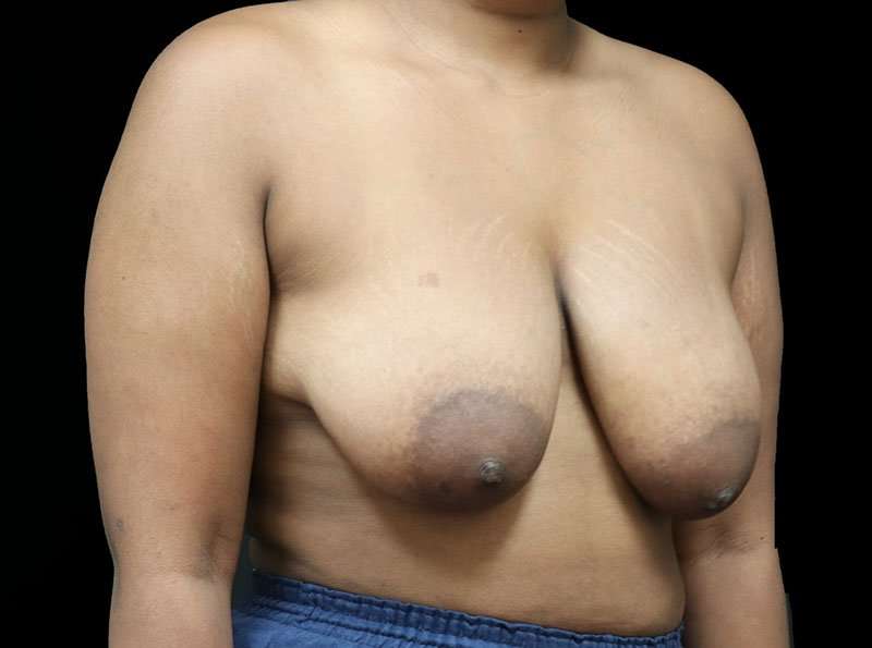 Breast Reduction Before & After Patient #2729
