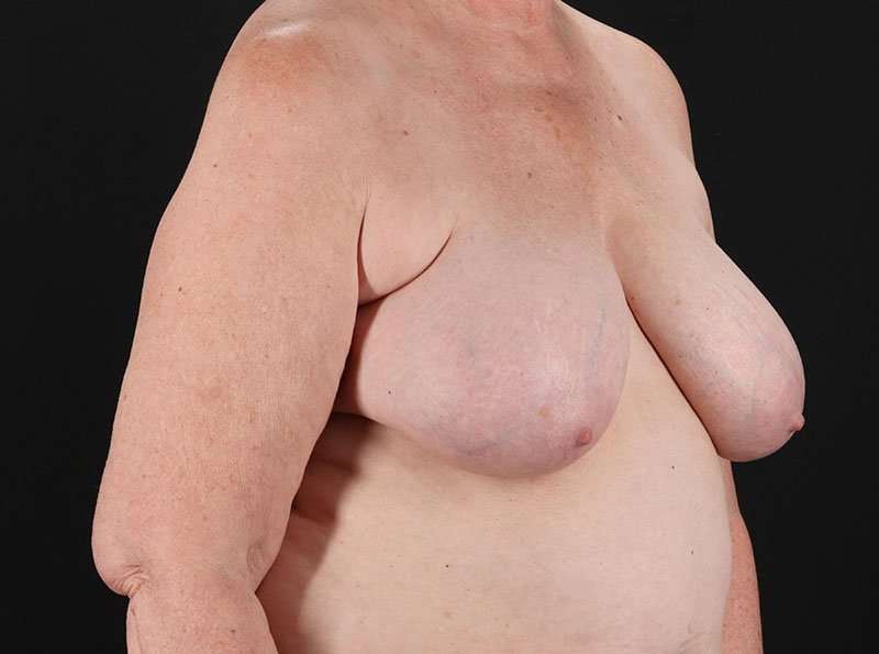Breast Reduction Before & After Patient #2766