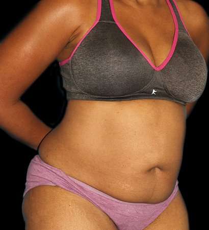Abdominoplasty (Tummy Tuck) Before & After Patient #790