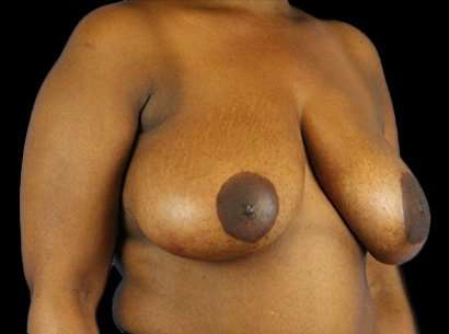 Breast Reduction Before & After Patient #2870