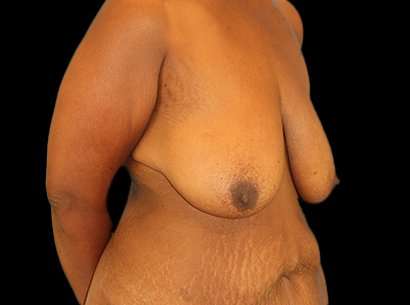 Breast Reduction Before & After Patient #2881
