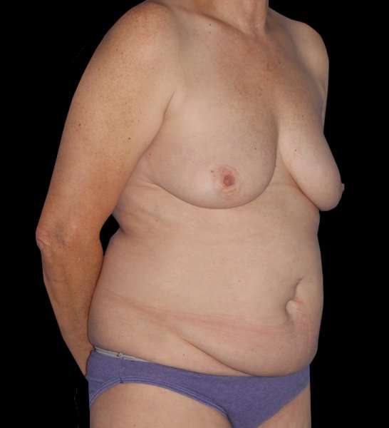 DIEP Flap Before & After Patient #2943