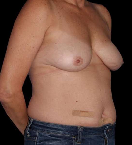 DIEP Flap Before & After Patient #2962