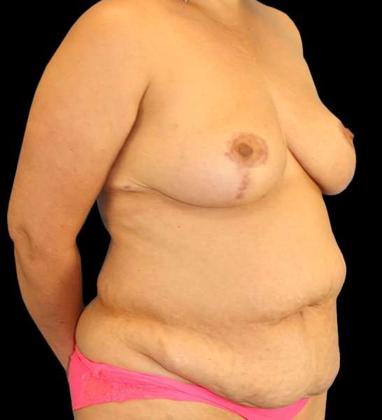 DIEP Flap Before & After Patient #2974