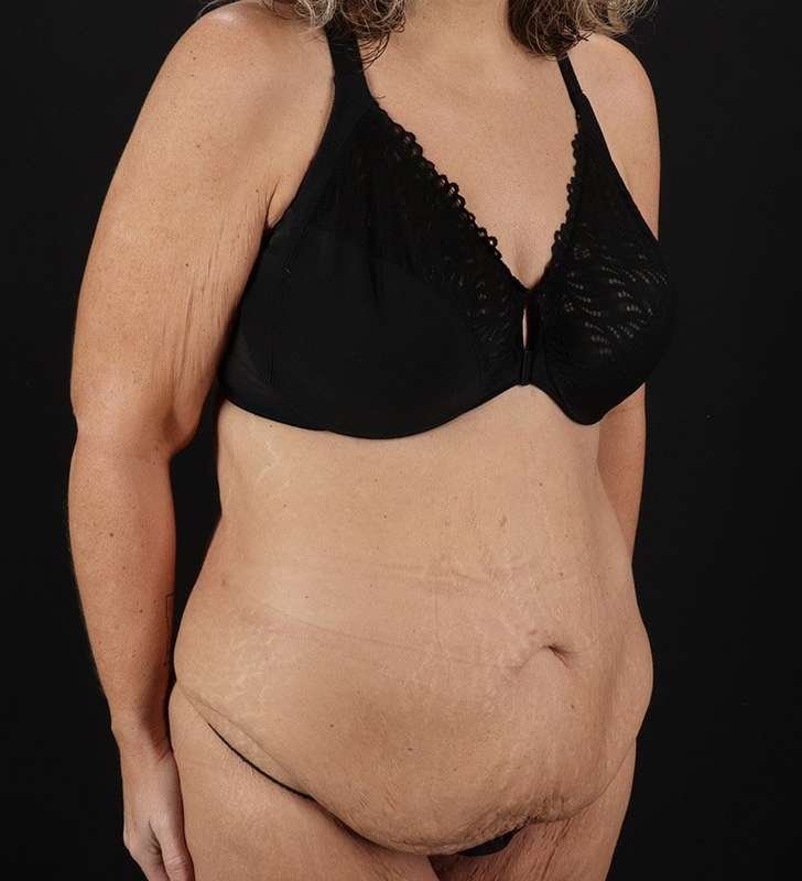 Abdominoplasty (Tummy Tuck) Before & After Patient #817