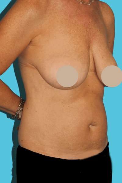 DIEP Flap Before & After Patient #3096