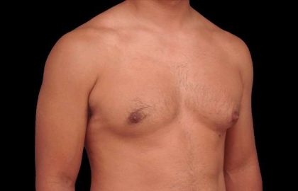 Gynecomastia Before & After Patient #3130