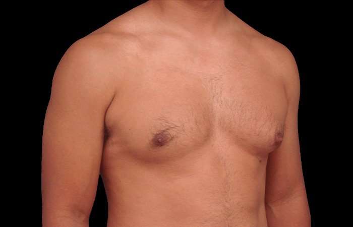 Gynecomastia Before & After Patient #3130