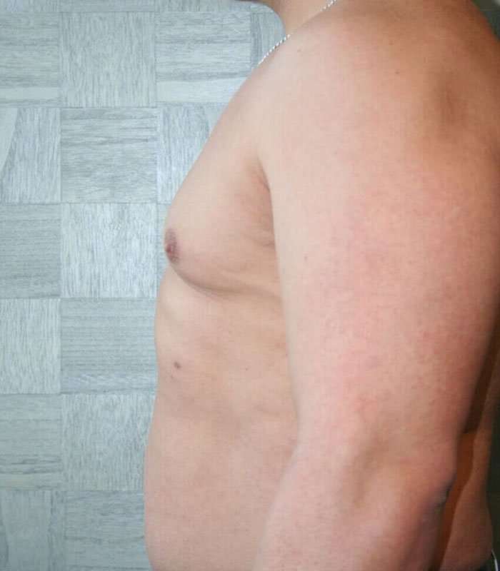 Gynecomastia Before & After Patient #3135
