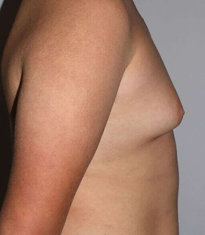 Gynecomastia Before & After Patient #3140
