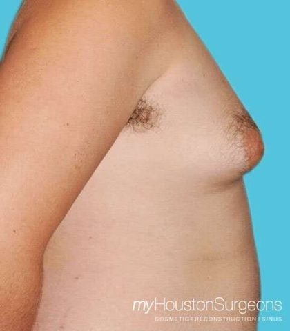 Gynecomastia Before & After Patient #3145