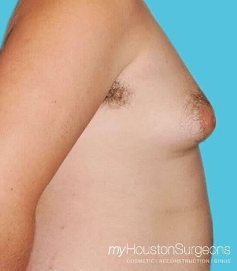 Gynecomastia Before & After Patient #3145