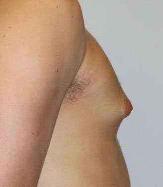 Gynecomastia Before & After Patient #3151