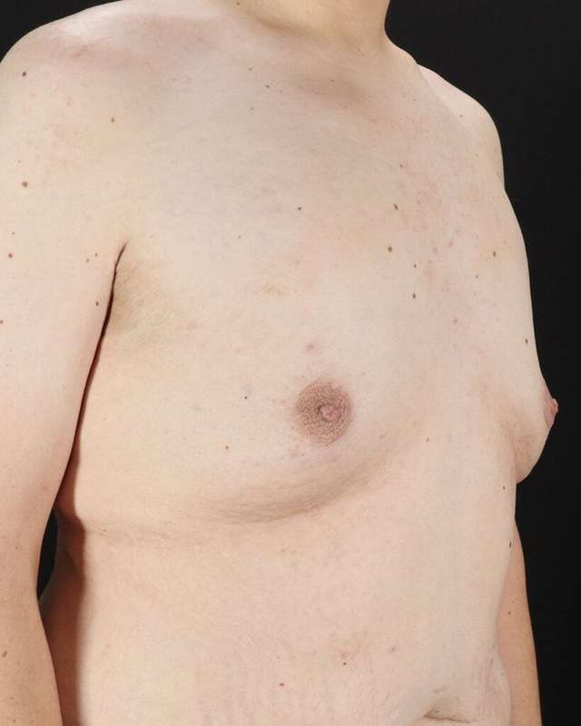 Gynecomastia Before & After Patient #3162