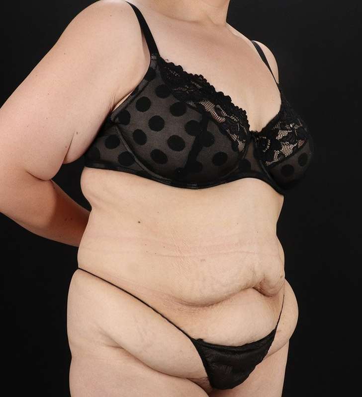 Abdominoplasty (Tummy Tuck) Before & After Patient #830