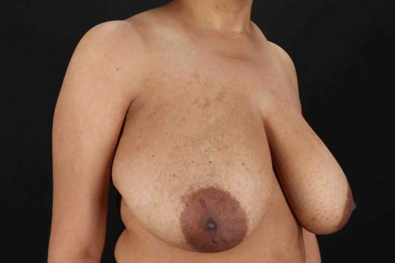 Breast Reduction With Lift Before & After Patient #3323