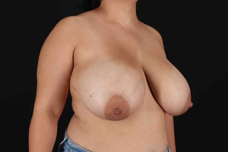 Breast Reduction With Lift Before & After Patient #3334
