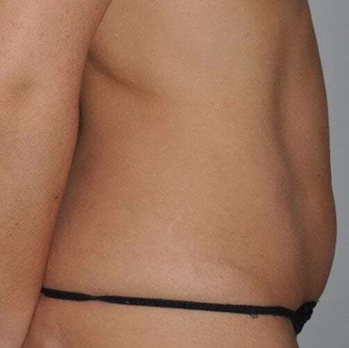 Abdominoplasty (Tummy Tuck) Before & After Patient #848